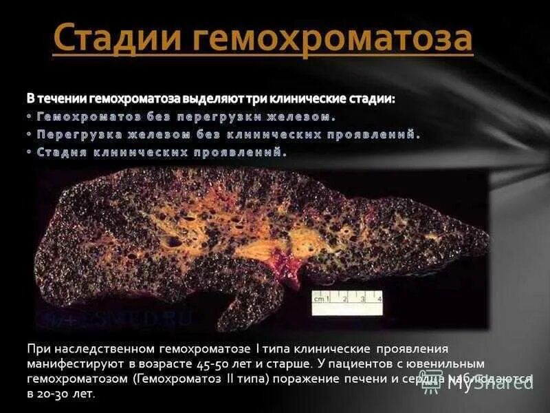 Без гемохроматозов