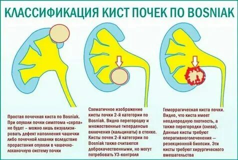 Кисты в почках причины у женщин