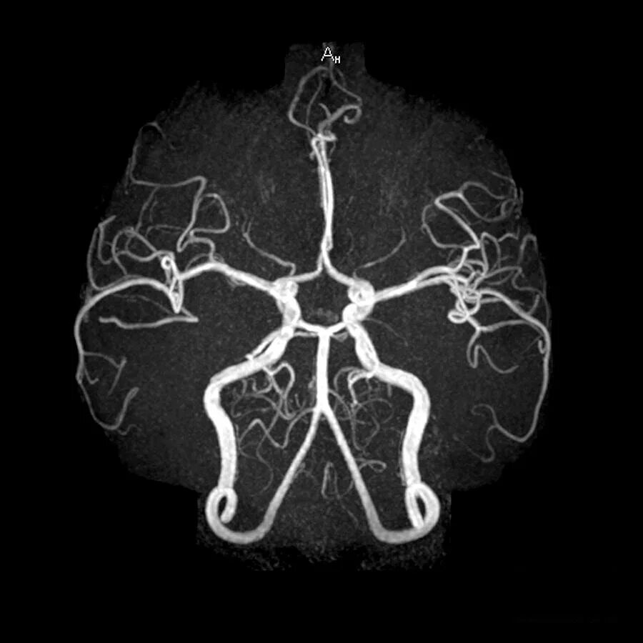 Сосуды головного мозга норма. МРА (магнитно-резонансная ангиография). Кт ангиография артерий головного мозга. Мрт ангиограмма сосудов головного мозга. Мрт ангиография артерий головного мозга.
