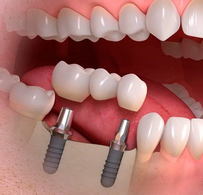 Мостовидный протез на 2 имплантах. Внутрикостная дентальная имплантация. Имплант мостовидный на 3 зуба. Зубной мост мостовидный протез.
