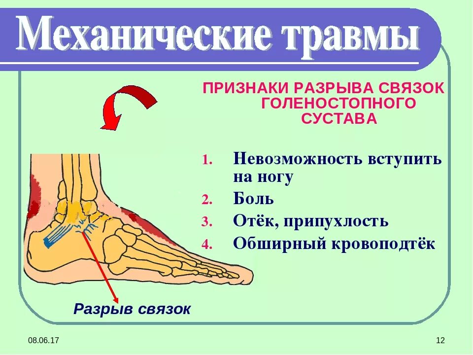 Ушибы растяжения разрывы связок. Травма голеностопа с повреждением связок. Травма капсульно-связочного аппарата голеностопного сустава. Повреждение связок голеностопного сустава 1 степени. Разрыв связок голеностопного сустава.