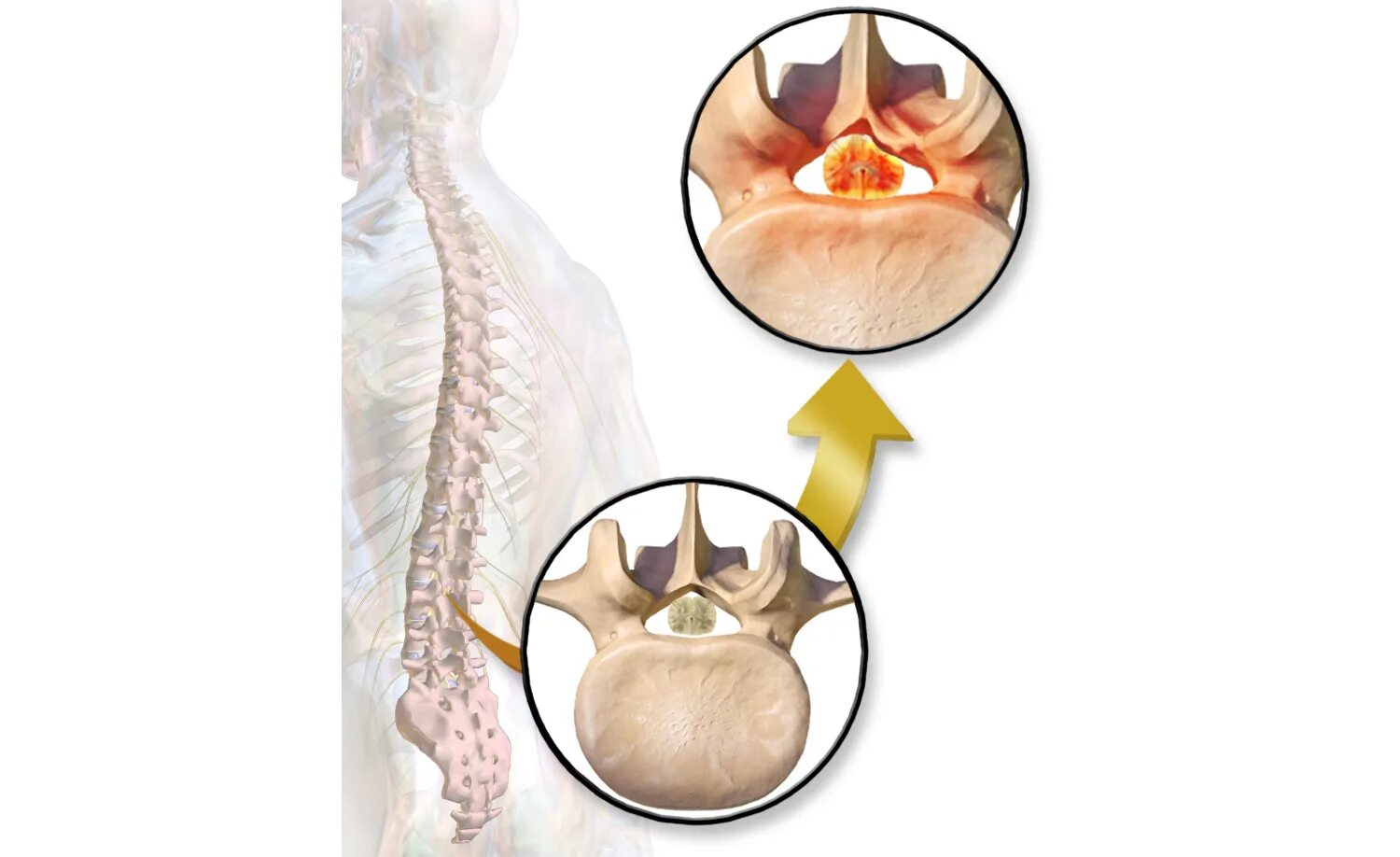 Декомпрессия корешков позвоночника. Стеноз ла у грудного ребенка. Абсолютный и относительный стеноз позвоночного канала мрт. Показания к стентированию коронарных артерий. При каком стеноз делают операцию.
