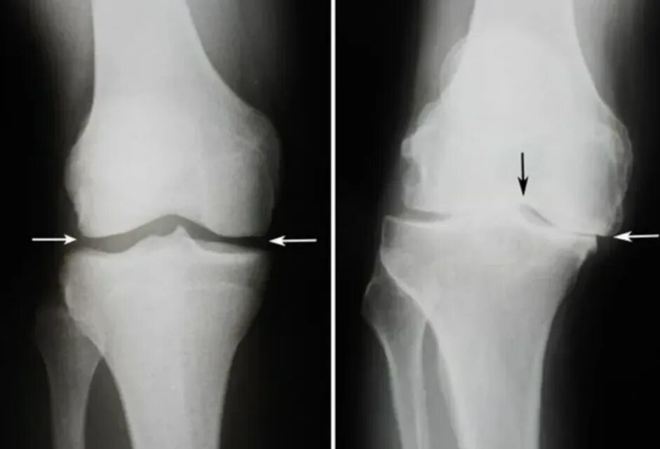 Деформирующий артроз рентген. Деформирующий гонартроз рентген. Артрозо-артрит коленного сустава рентген. Гонартроз коленного сустава рентген. Сужение коленных суставов