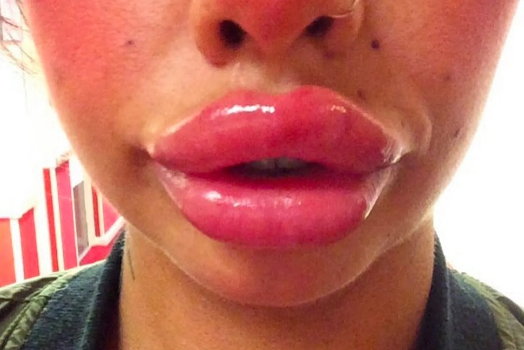 Свисающие губы пельмешки. Увеличенные губы пельмени. Увеличение губ вареники. Princess volume для губ результат. Губы пельмени.