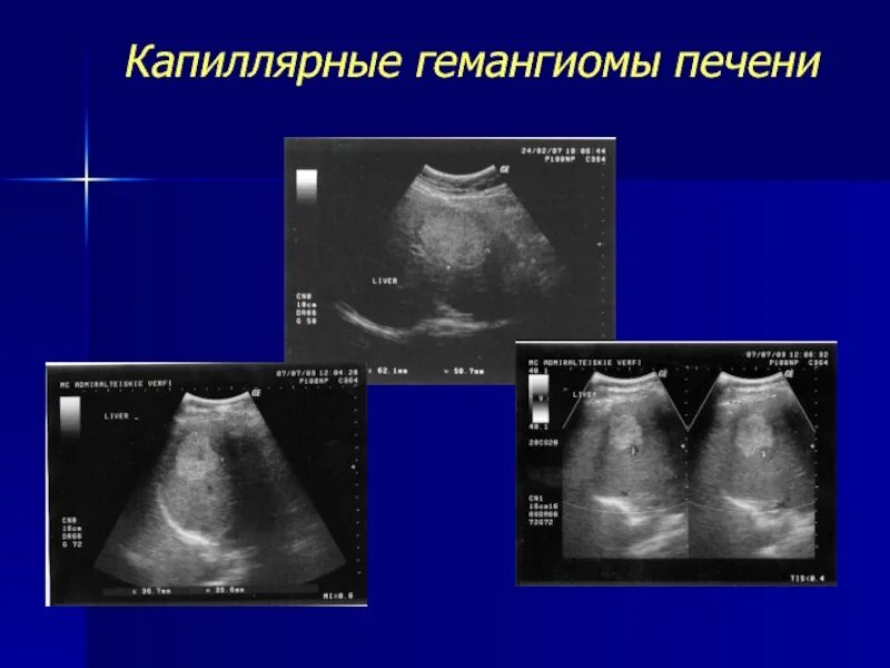 При гемангиоме печени можно ли. Гемангиома печени на УЗИ описание.