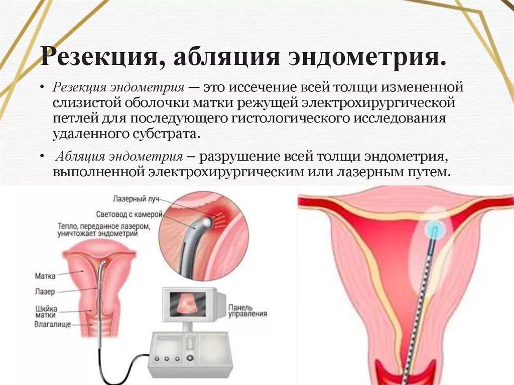 Абляция эндометрия гистероскопическая. Гиперплазия эндометрия выскабливание. Резекцию или абляцию эндометрия.