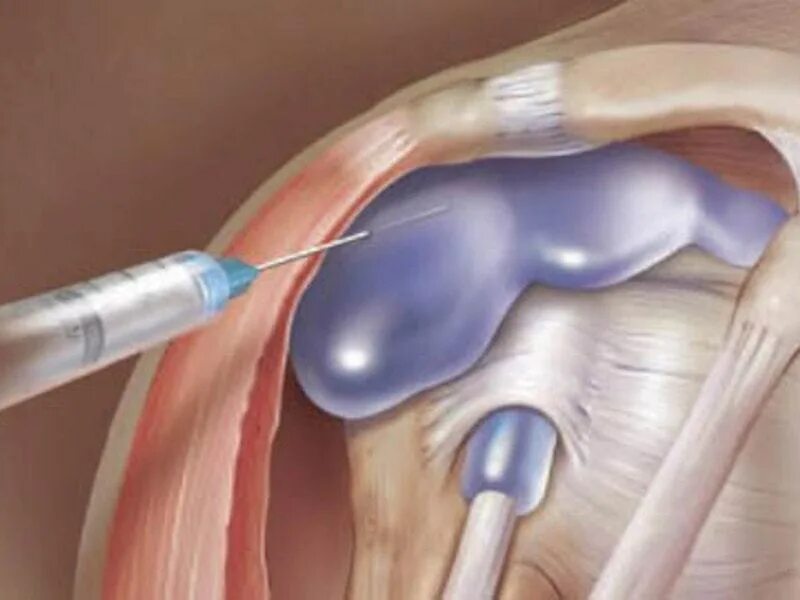 Температура после пункции. Субакромиальный бурсит. Плечелопаточный периартрит блокада. Синовит коленного сустава пункция. Субдельтовидный бурсит.