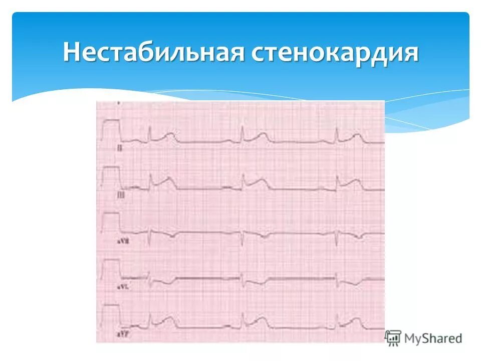 Экг при нестабильной стенокардии напряжения. Ритм при стенокардии. Стенокардия напряжения экг расшифровка. Экг критерии нестабильной стенокардии. Экг при ибс стенокардия напряжения 2 фк.