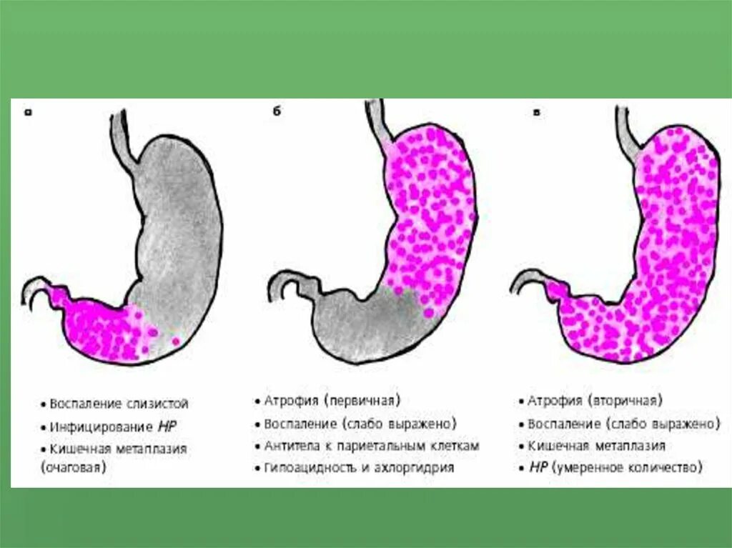 Очаговый атрофический гастрит. Атрофический гастрит степени. Степень и стадия атрофии желудка. Атрофический гастрит культи желудка. Слизистая атрофична