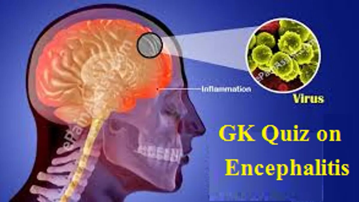 Энцефалит нейроинфекция. Воспалительные поражения головного мозга. Энцефалит головного мозга. Мозжечковый энцефалит. Энцефалит головного мозга у взрослых