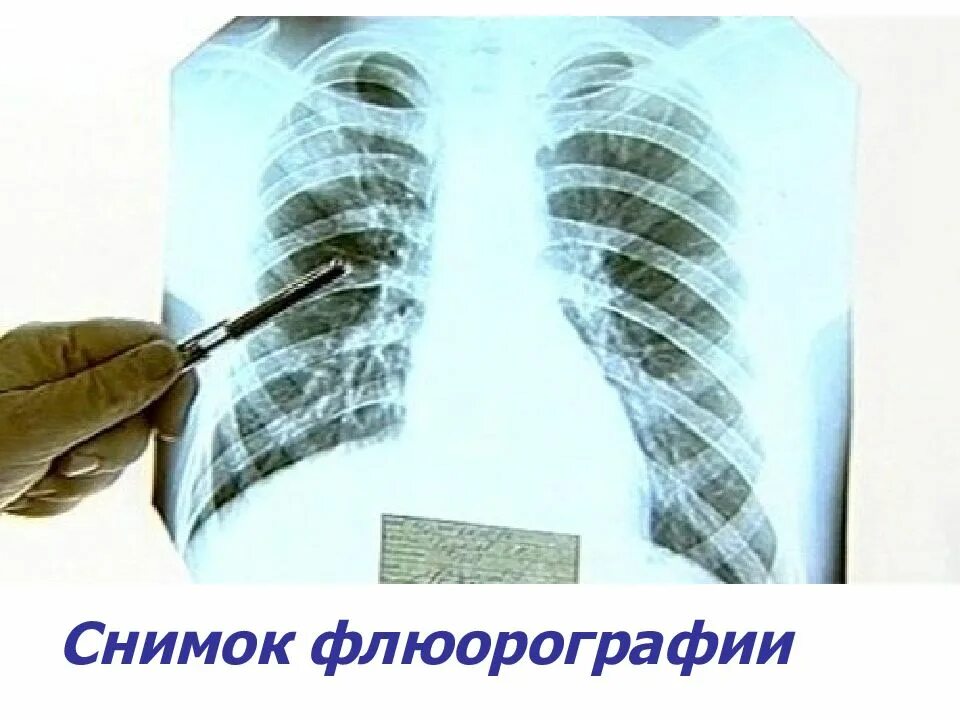 Что такое флюорография в школе. Флюорография. снимок флюорографии. снимки флюорографии. флюорография снимок легких.