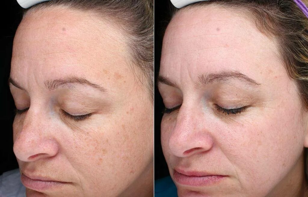 пилинг vichy ночной. ночной пилинг. ночной пилинг отзывы. ночной пилинг отзывы. пьер рико пилинг.