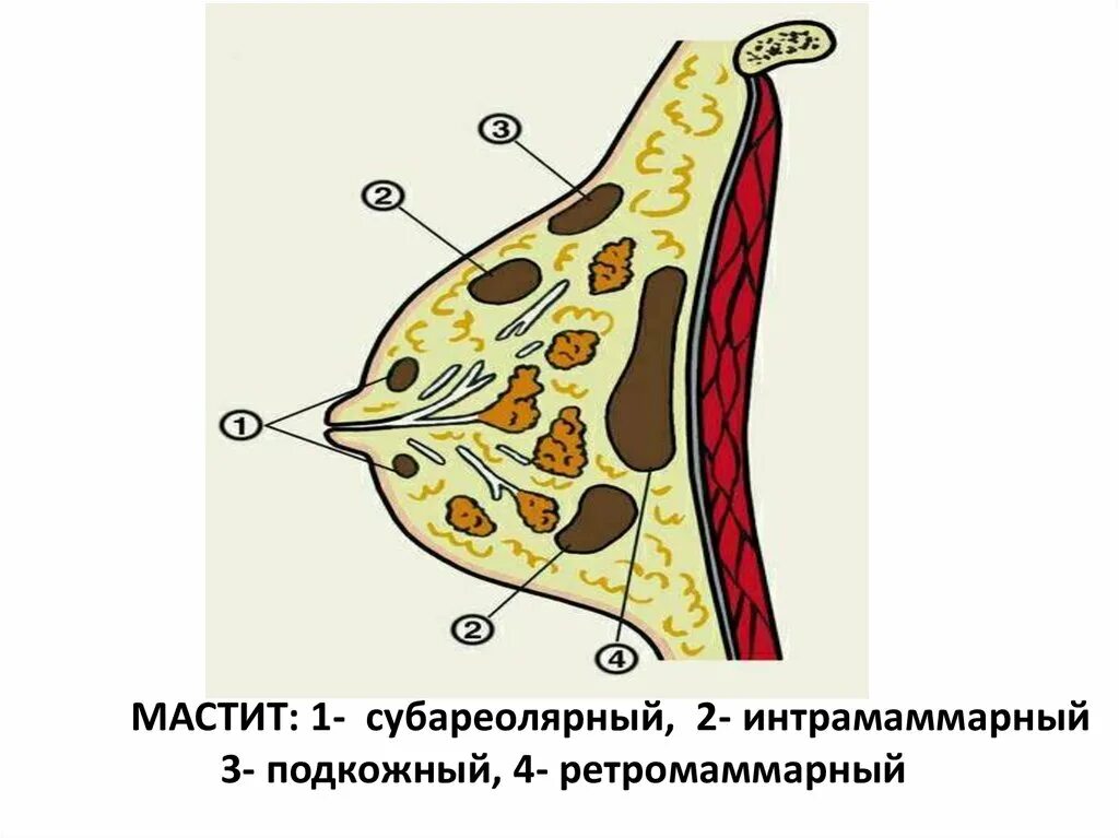 Послеродовый мастит. Субареолярный Гнойный мастит. Интрамаммарный Гнойный мастит. Мастит подкожный субареолярный интрамаммарный. Мастит серозный инфильтративный Гнойный.