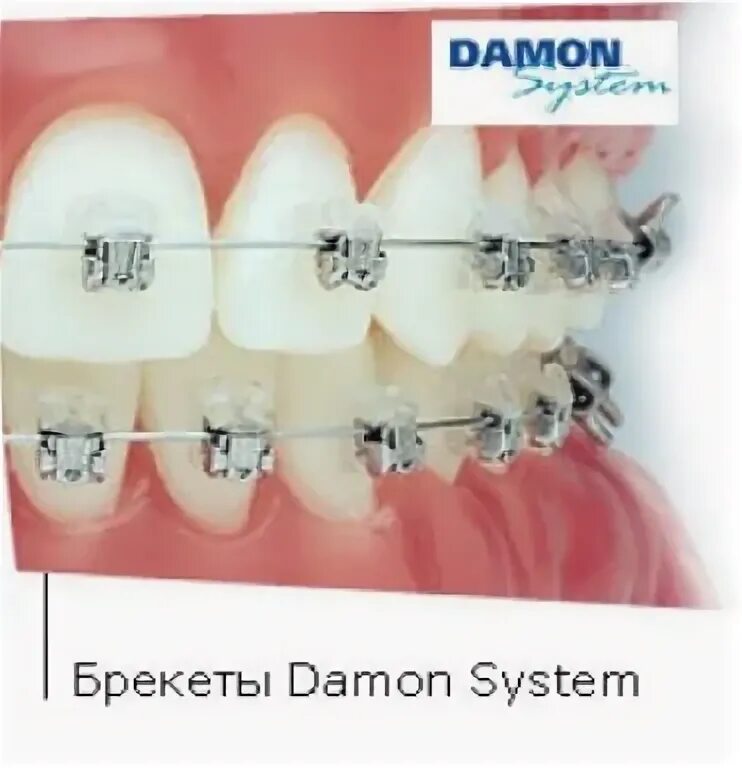 Брекета 22. Dynaflex mtx брекеты. Красивые девушки с брекетами. Брекета 22. Брекеты металлические лигатурные mdm что это.