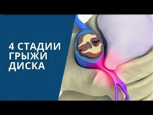 Стадии грыжи диска