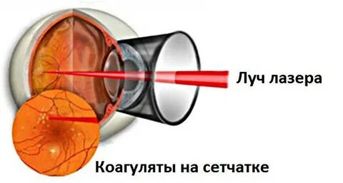 Лазерная коагуляция после операции