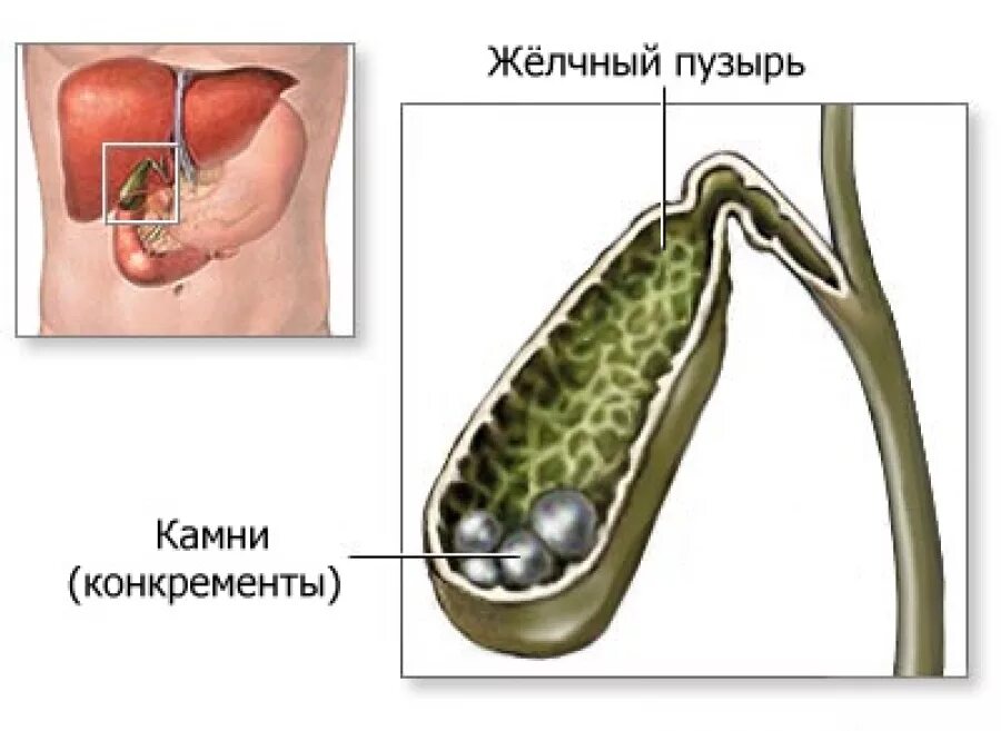 Камень в протоке желчного пузыря что делать. Желчекаменная болезнь холелитиаз. желчный пузырь желчнокаменная болезнь. жкб камни желчного пузыря. конкременты желчного пузыря что это такое.