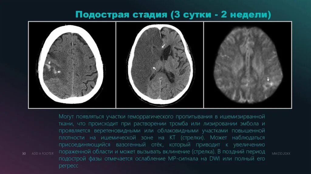 Инсульт левого полушария головного. Ишемический инсульт с геморрагическим пропитыванием на кт. Подострая фаза ишемического инсульта кт. Геморрагическое пропитывание мозга. Геморрагическое пропитывание вещества мозга это.