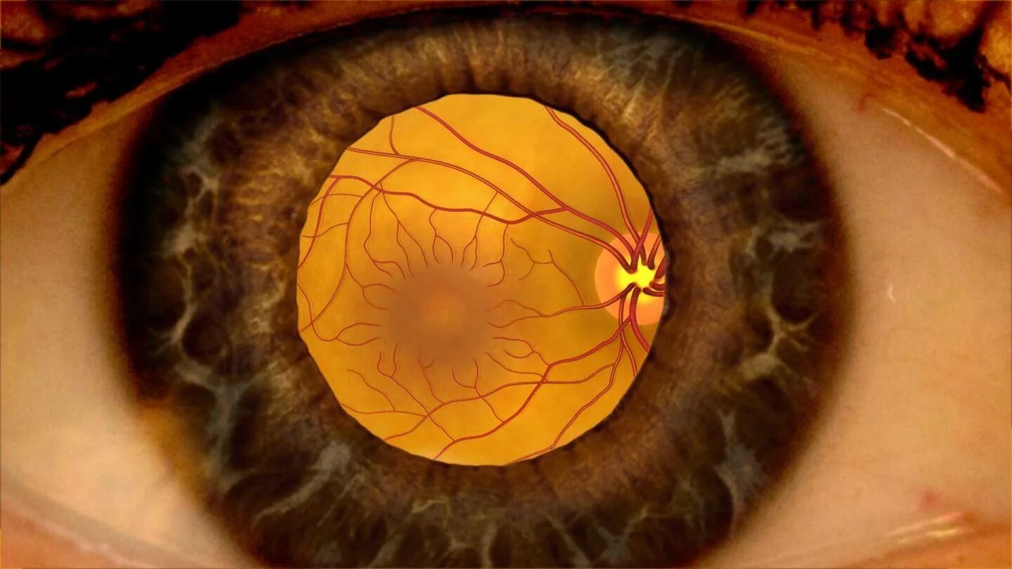 Изображение на сетчатке глаза появляется. Макулодистрофия, макулярная дегенерация. Пигментная макулодистрофия. Ангиопатия сетчатки мкб. Пигментный ретинит сетчатки.