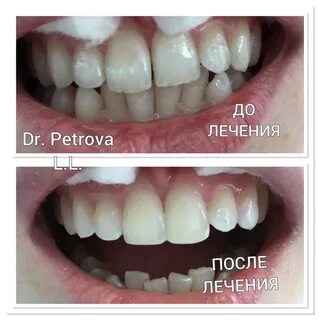 Ли щель