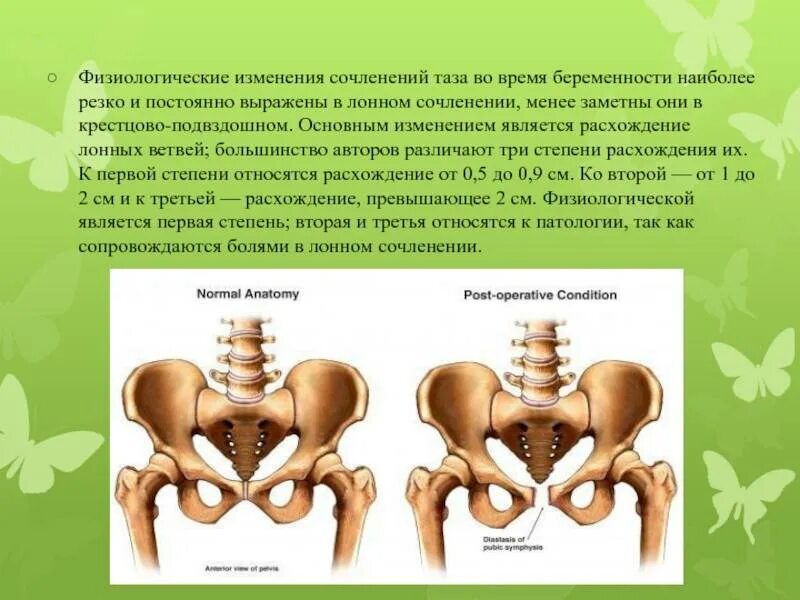 Изменения костей таза