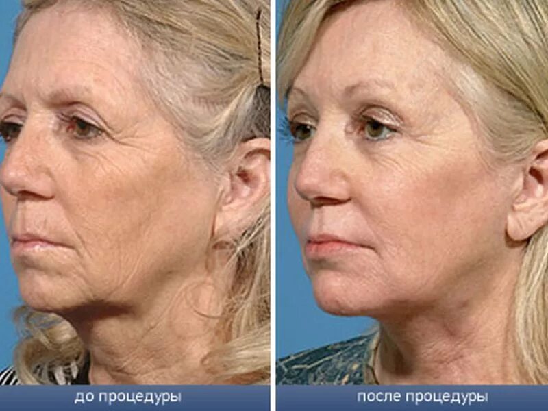 Плазмолифтинг отзывы фото до и после лицо. Плазмолифтинг для лица. Плазменная подтяжка лица.