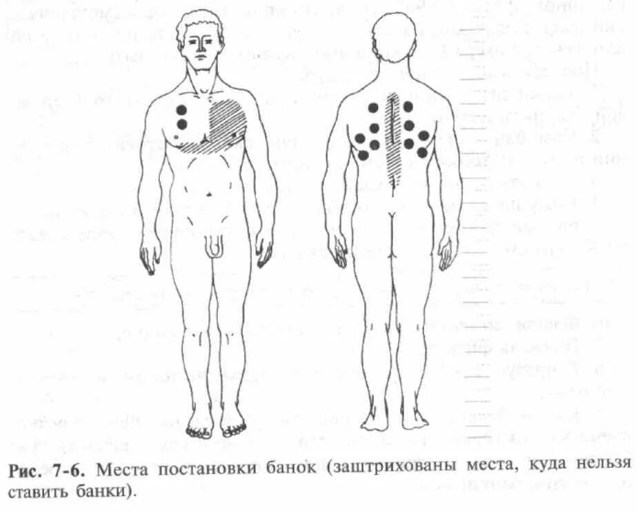 На сколько ставят банки на спину взрослым. Схема постановки банок при пневмонии. Места постановки медицинских банок. Постановка вакуумных банок. Постановка банок места постановки.