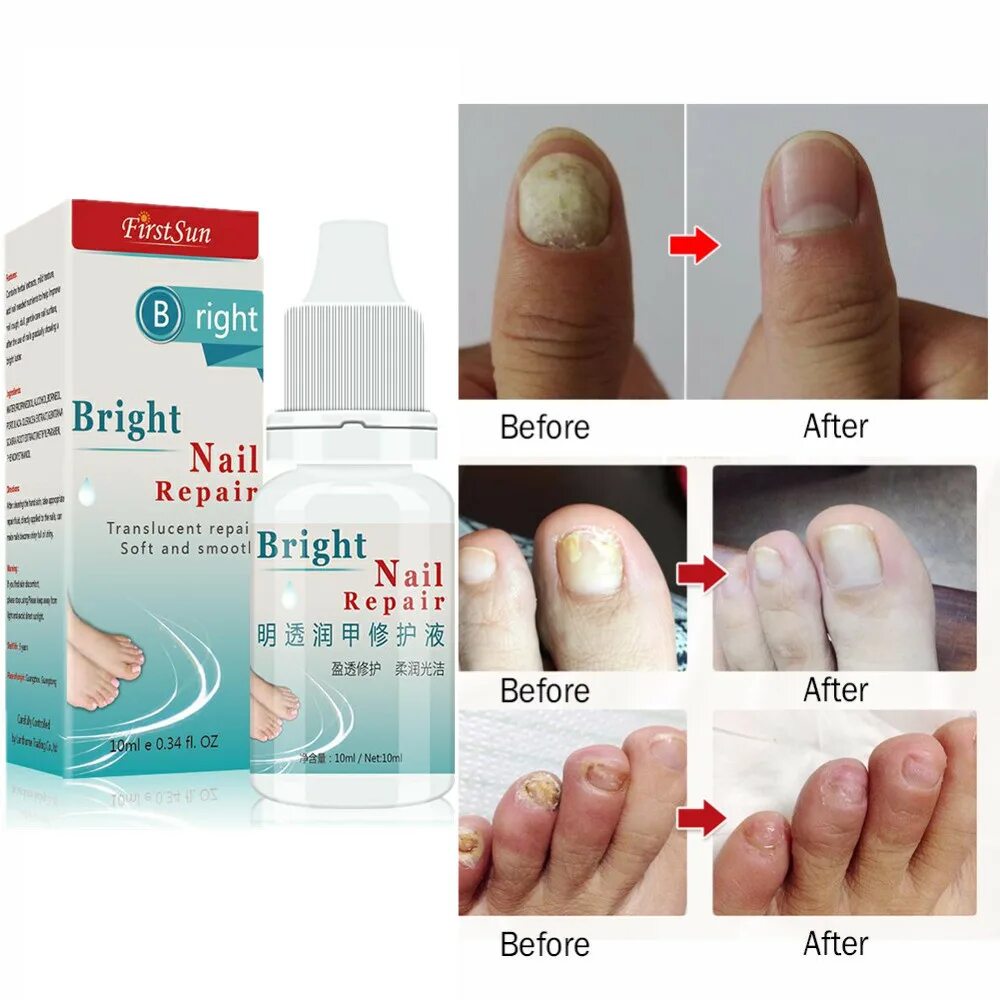 Гель от грибка ногтей отзывы. Средство от грибка ногтей Bright Nail Repair. Nail Repair лак для ногтей.