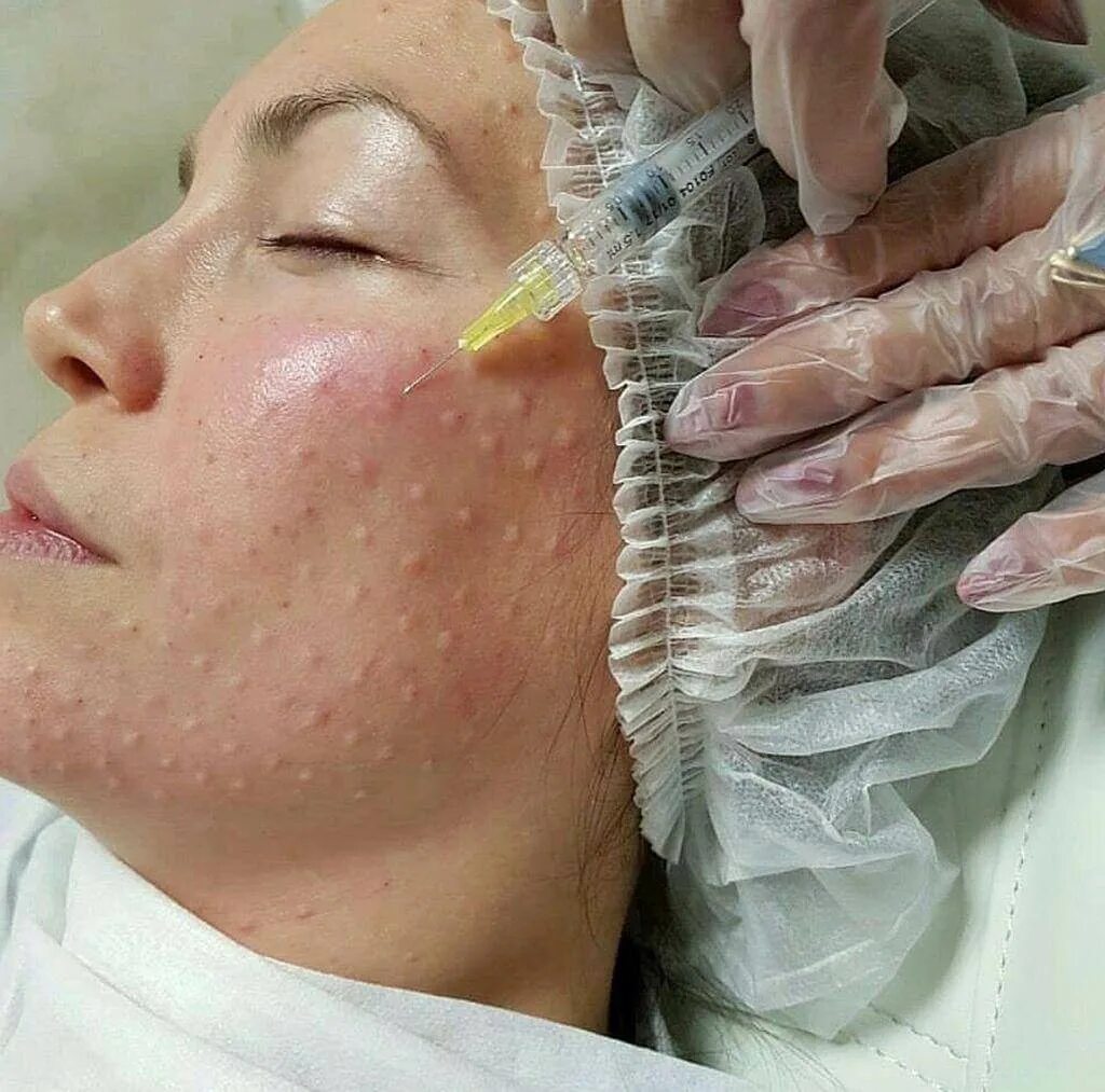 Мезотерапия кожи лица skinlift ru. Техника наппаж биоревитализация. Техника наппаж мезотерапия. Биоревитализация Киара.