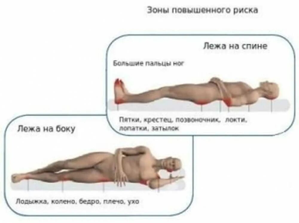 Чем обрабатывать пролежни у лежачих. Зоны риска образования пролежней. Места образования пролежней лежа на спине.