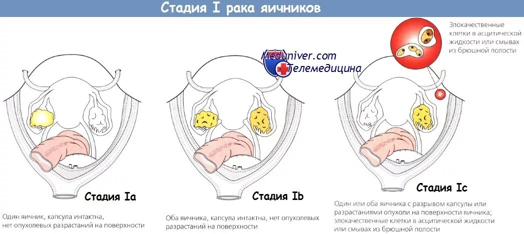 3 стадия рака с метастазами