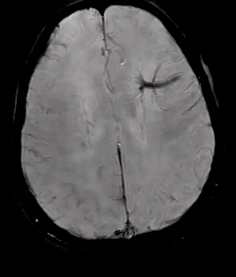 Венозная ангиома головного мозга кт. Венозная ангиома мозжечка. Ангиома правой лобной