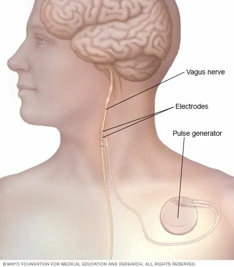Стимулятор блуждающего нерва. Вагус и эпилепсия. Вагус нерв. Вагус стимулятор. Блуждающий нерв.