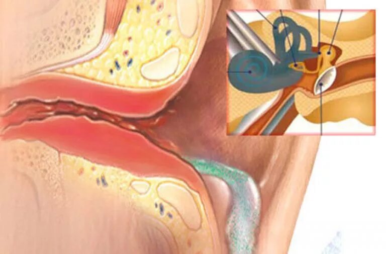 Заложенность уха тубоотит. Евстахиит воспаление слуховой трубы.