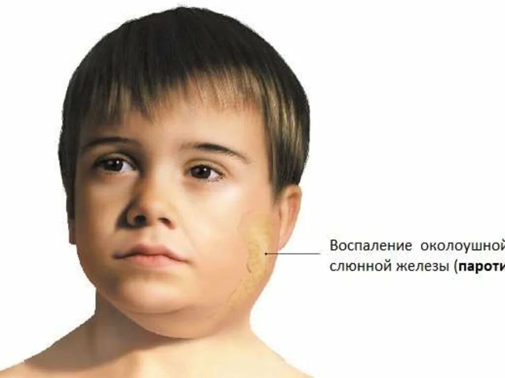 Больной свинкой. Свинка эпидемический паротит. Паротит воспаление околоушной железы. Эпидемический паротит у детей симптомы. Свинка болезнь симптомы.
