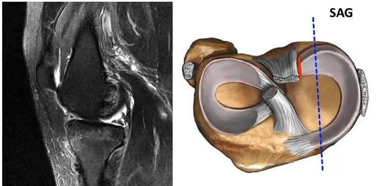 Разрыв медиальной. Повреждение мениска медиального мениска. Менисцит медиального мениска коленного сустава что это. Капсулярный разрыв мениска. Разрыв заднего рога мениска коленного сустава.