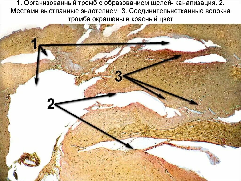 Красный тромб с началом организации. Организация и канализация тромба. Тромб с началом организации. Организация тромба