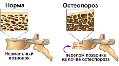 Остеопороз разрушение костей?. Нормальная кость и остеопороз. Остеопороз риск переломов. Симптомы вторичного остеопороза.