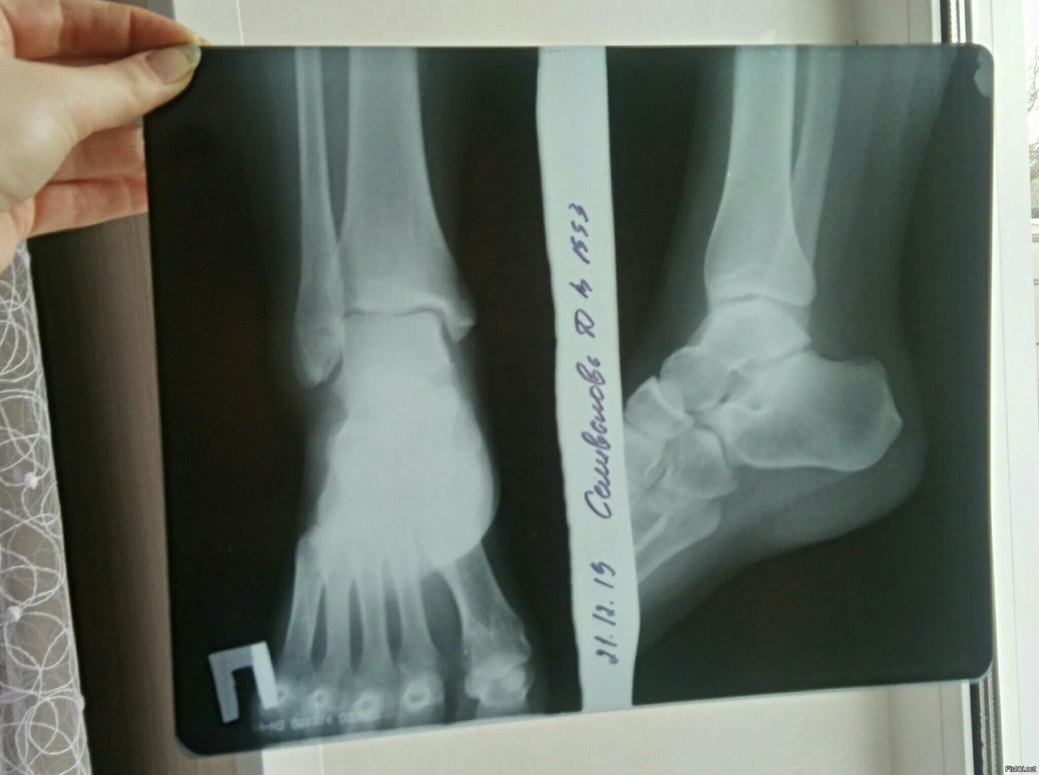 Снимок ноги рентген.