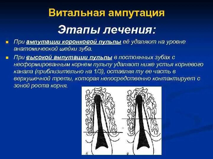 Метод ампутации пульпы. Витальная ампутация пульпита. витальная ампутация пульпы этапы. метод витальной ампутации пульпы. пульпит метод витальной ампутации.