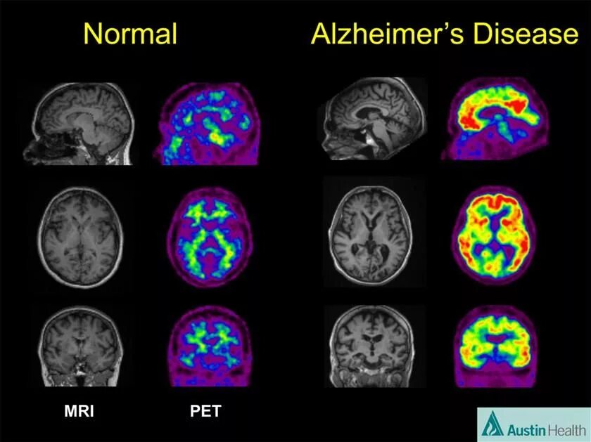 Brain disease. Позитронно эмиссионная томография болезнь Альцгеймера. ПЭТ кт при Альцгеймера. Болезнь Альцгеймера снимки мрт. Кт и мрт при болезни Альцгеймера.