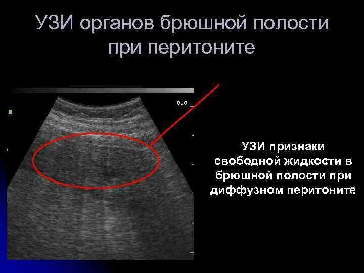 Ультразвуковые признаки перитонита. Жидкость в брюшной полости УЗИ перитонит. УЗИ признаки наличия свободной жидкости в брюшной полости. Свободная жидкость в брюшной полости на УЗИ.