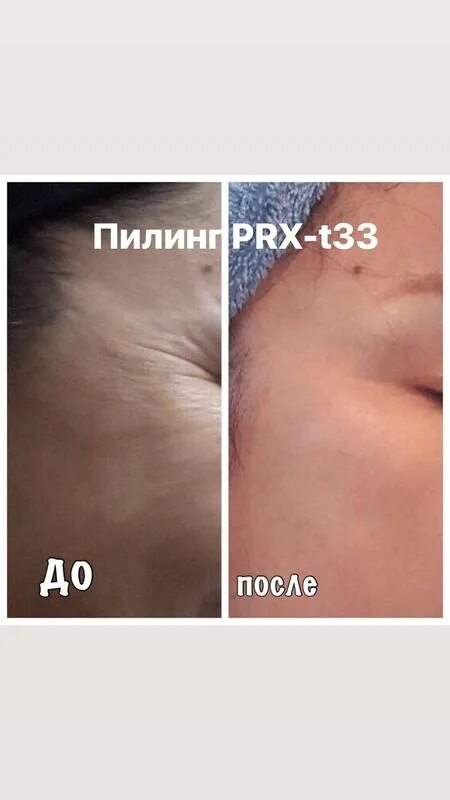T33 пилинг отзывы. Prx-t33. Prx-t33. Акции косметология москва. T33 пилинг отзывы.