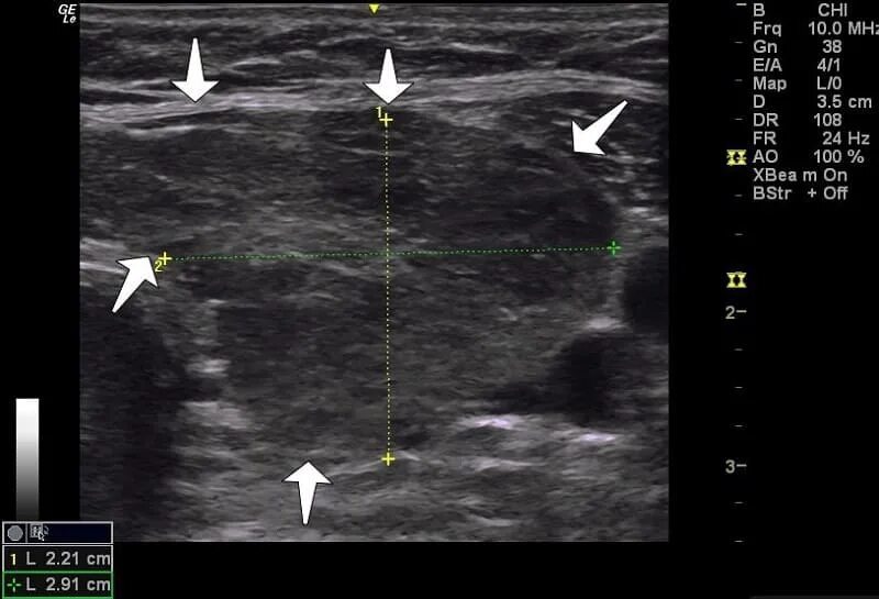 узи. узи щитовидной железы узелки. коллоидный узел щитовидной железы на узи. эхограммы узлы щитовидной железы. сонограмма щитовидной железы.