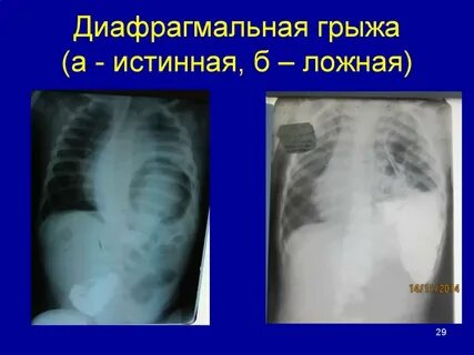 Истинные и ложные грыжи