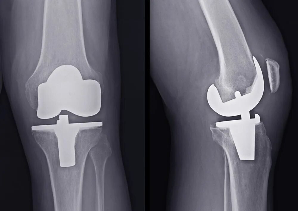 имплантация эндопротеза. коленный эндопротез зиммер. тотальное эндопротезирование коленного сустава. эндопротез тазобедренного сустава zimmer. эндопротезирование коленного.