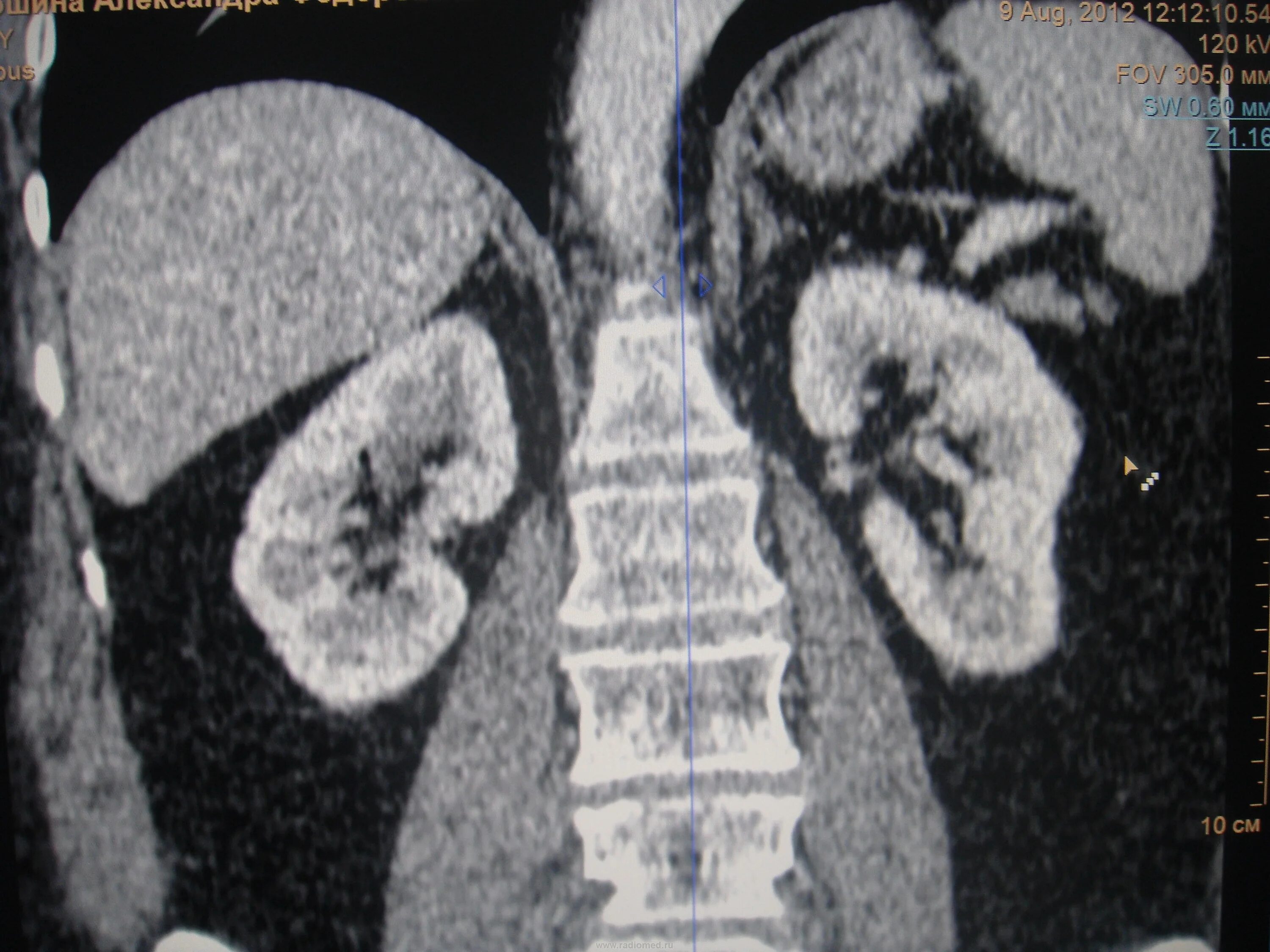Горбатая почка рентген. Горбатая и дольчатая почка. Горбатая почка