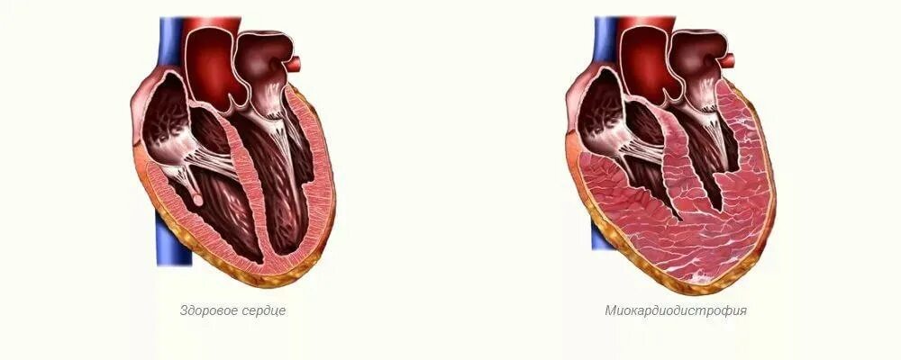 Дистрофический изменения в мирокарде. Изменение миокарды сердца что это. Миокардиодистрофия эхокардиография. Метаболические изменения в миокарде. Эксцентрическая гипертрофия миокарда.