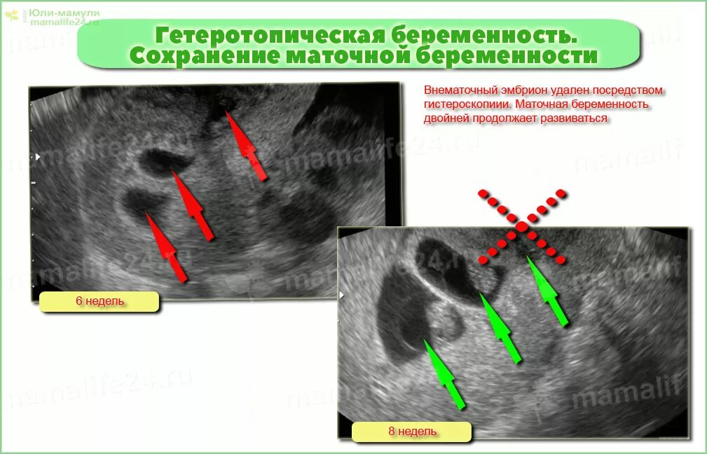 Ли сохранить внематочную беременность. Внематочная беременность. Внематочная беременнос. Гетеротопической беременности.