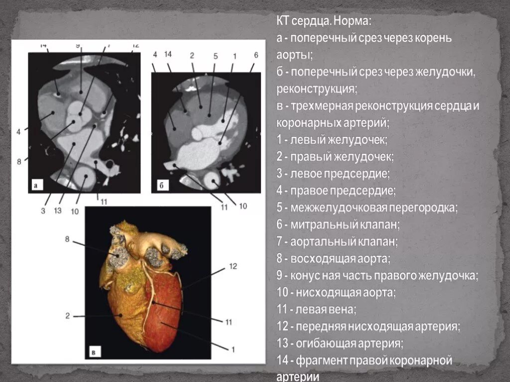 Кт анатомия сердца. Толщина желудочков сердца в норме. Размеры сердца на кт норма.